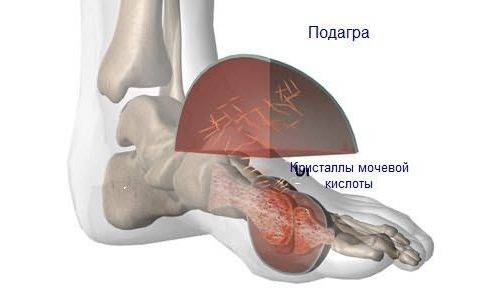 Скопление кристаллов мочевой кислоты при подагре Скопление кристаллов мочевой кислоты при подагре