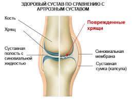Хондропротекторы для суставов