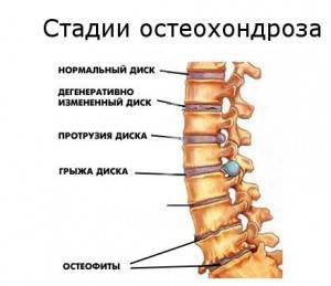 шейный остеохондроз стадии