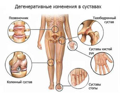 Дегенеративные изменения