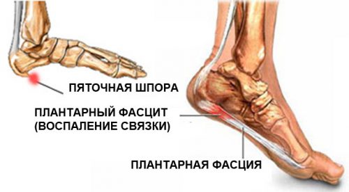 Плантарный фасциит Плантарный фасциит