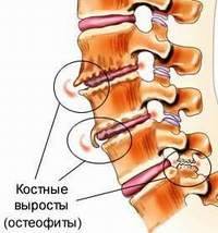 остеофиты позвоночника