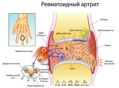 revmatoidnyiy