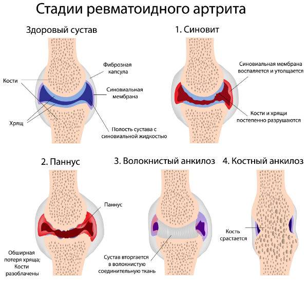 Стадии ревматоидного артрита