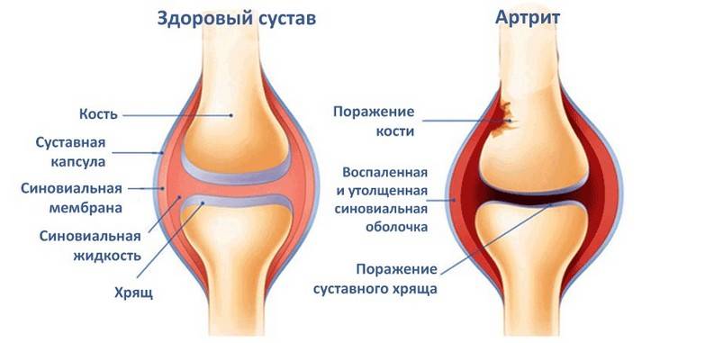 Артрит сустава