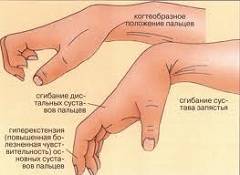 Анкилоз лучезапястного сустава
