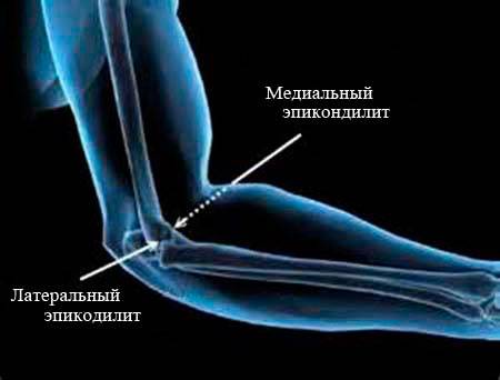 Латеральный и медиальный эпикондилит