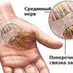 Синдром карпального канала