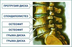 Виды патологий позвоночника