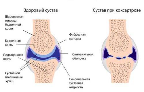 Строение тазобедренного сустава