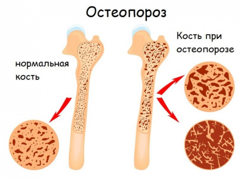 Остеопороз Остеопороз