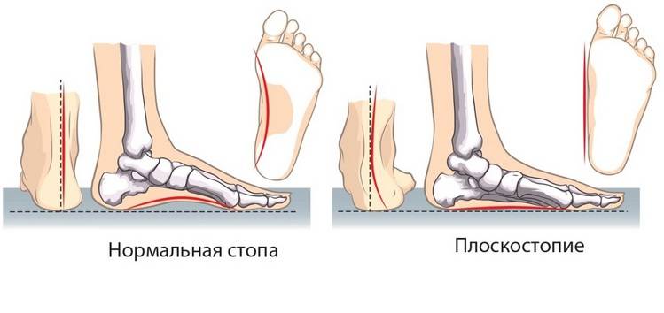 Сравнение нормальной стопы и плоскостопия Плоскостопие