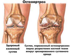 остеоартроз колена