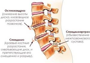 спондилоартроз поясничного отдела позвоночника что это такое