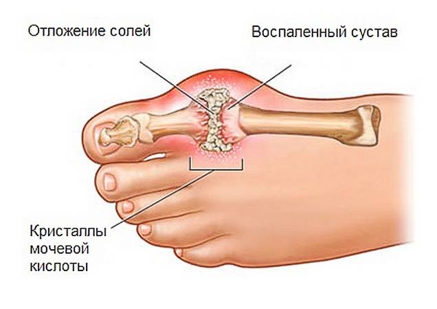 Сустав большого пальца стопы поражен подагрой Подагра