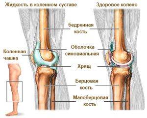 Здоровое и больное колено