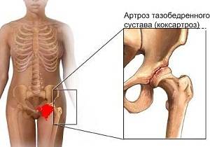 коксартроз тазобедренного сустава симптомы и лечение