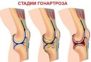 стадии артроза коленного сустава