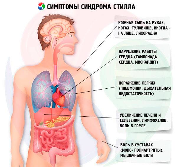 Болезнь Стилла