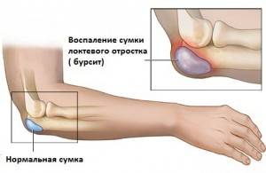 Хронический бурсит