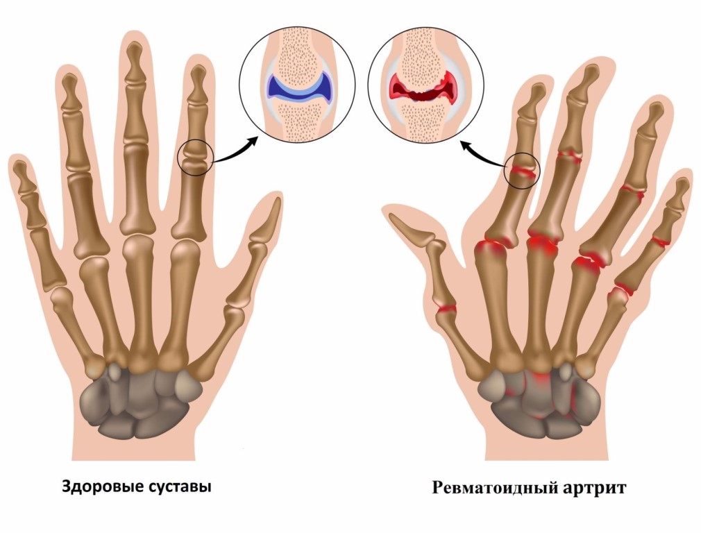 Серопозитивный артрит