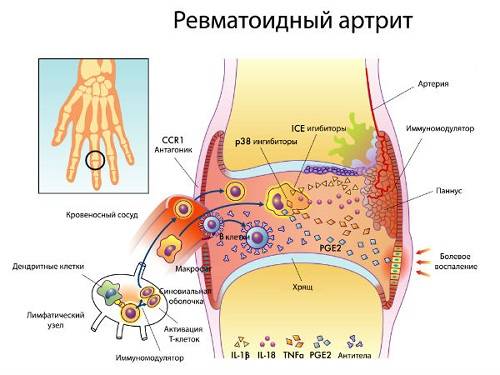Серопозитивный артрит