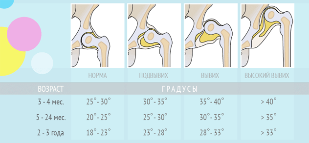 Степени дисплазии суставов