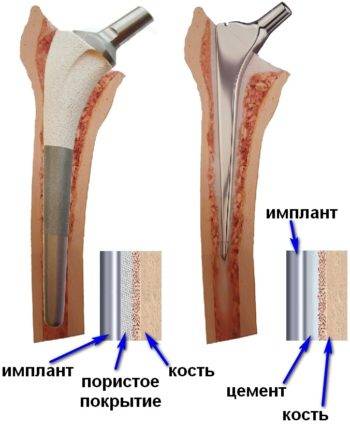 Эндопротезирование коленного сустава – восстановление функций сустава