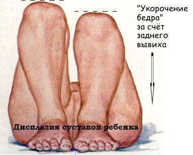 Дисплазия суставов ребенка