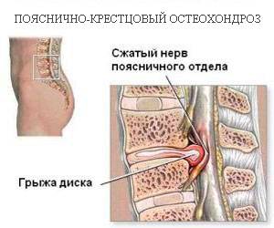 пояснично-крестцовый остеохондроз