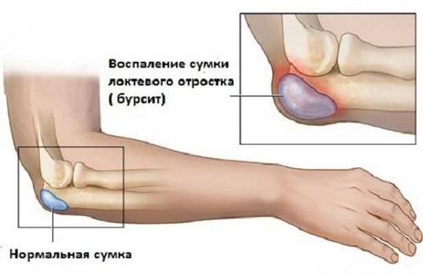 бурсит локтевого сустава