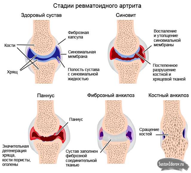 стадии ревматоидного артрита