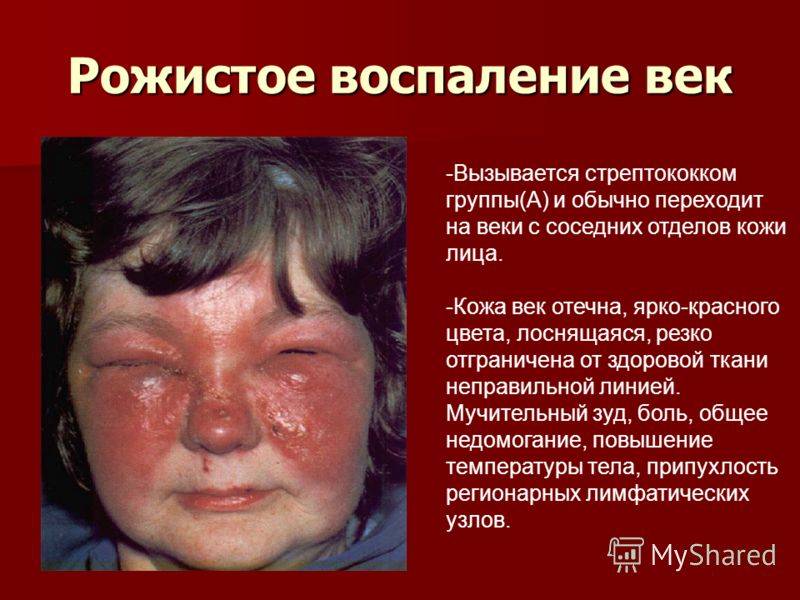 Рожистое воспаление