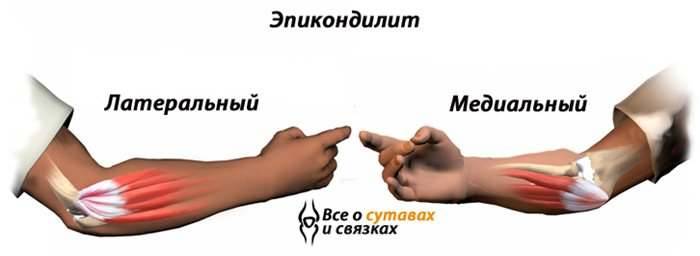 эпикондилит локтевого сустава лечение народными эпикондилит локтевого сустава лечение народными