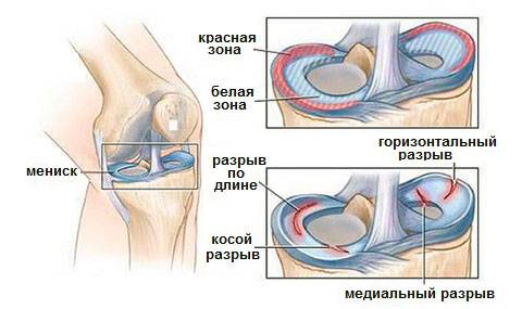 Травмы, вызывающие хруст и боли в коленях