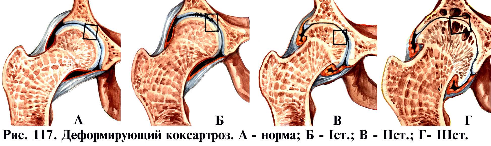 lechenie-koksartroza-tazobedrennogo-sustava-3-stepeni