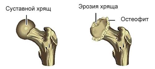 здоровый тазобедренный сустав и пораженный с остеофитами