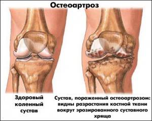 Остеоартроз коленного сустав