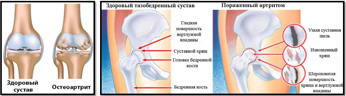 Артроз и спорт
