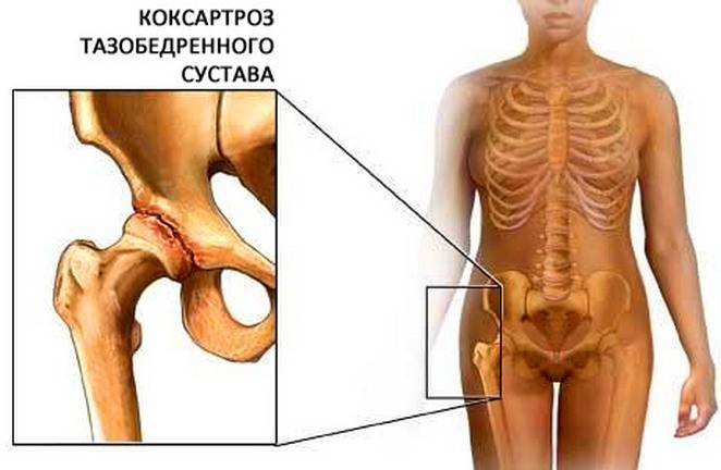 Коксартроз тазобедренного сустава Коксартроз тазобедренного сустава