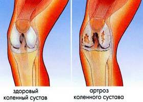 разрушение при артрозе