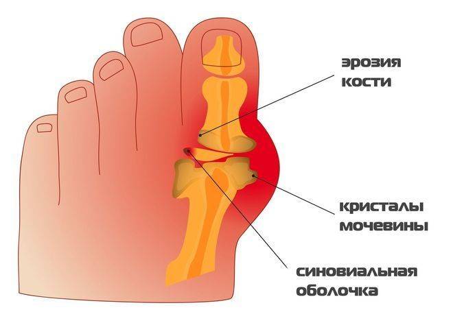 Схема образования заболевания
