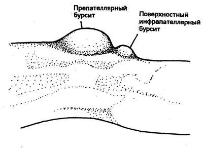 бурсит коленного сустава