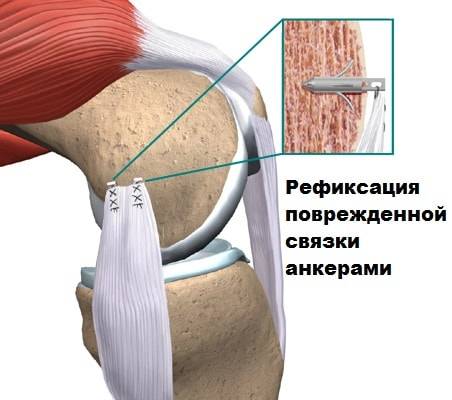 Рефиксация анкерами