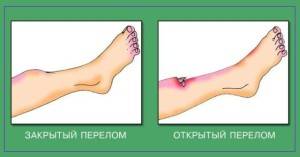 Как выглядит вывих