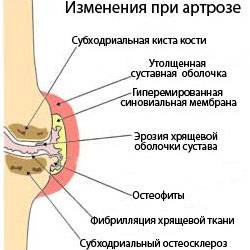 Изменения в суставе при артрозе