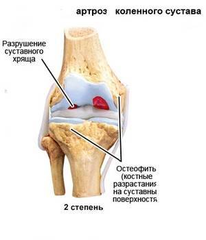 разрушение суставного хряща