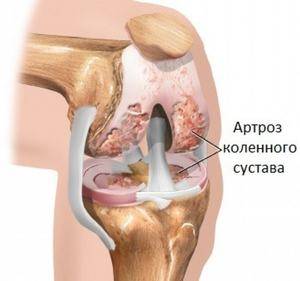 гонартроз