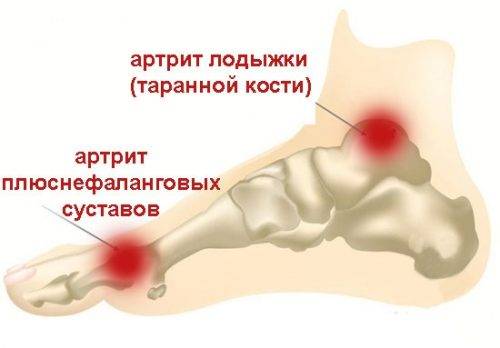 Расположение артрита стопы Расположение артрита стопы