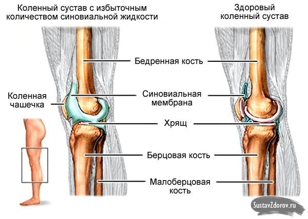 избыточное количество синовиальной жидкости в коленном суставе